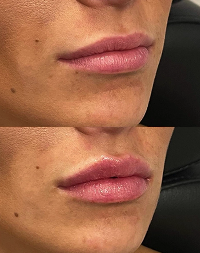 Cosmetic Treatments Albany Glens Falls The Artistry Of Face   2 Cheek Filler Before And After Photo By The Artistry Of Face In Albany Ny 1024x675 1.webp